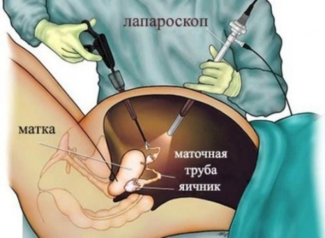 Лечение миомы матки тольятти thumbnail